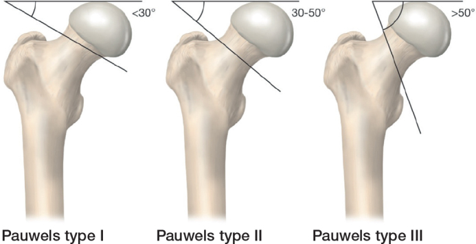 An Acta Orthopaedica educational article: Femoral neck fractures in adults with emphasis on surgical treatment.