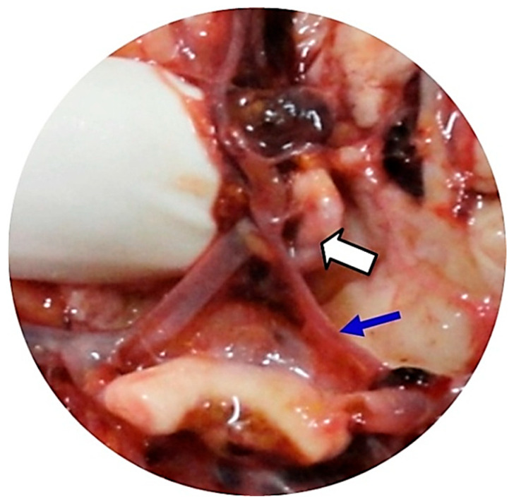 Comparing Antemortem CT-Angiography Data with Autopsy Findings in Regard to Anterior Communicating Artery Aneurysms.