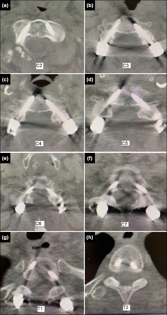 Outcome of cervical cases operated with posterior cervical pedicle screw placement: a single-center retrospective study.