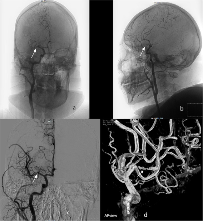 Intravenous tenecteplase thrombolysis and endovascular bridging intra-arterial tirofiban injection therapy in a pediatric case of acute ischemic stroke.