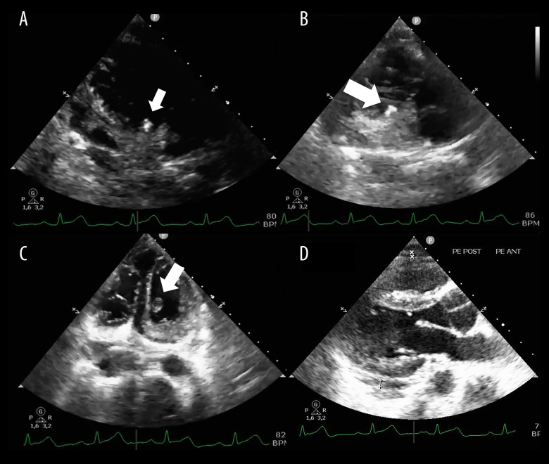Air Rifle Injury: Rare Bullet Lodgement in the Right Ventricle and Successful Surgical Removal.