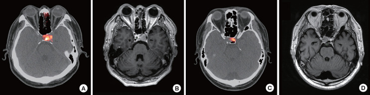 68Ga-DOTATOC PET/CT in the Localization of Pituitary Tumors in Cushing's Disease.