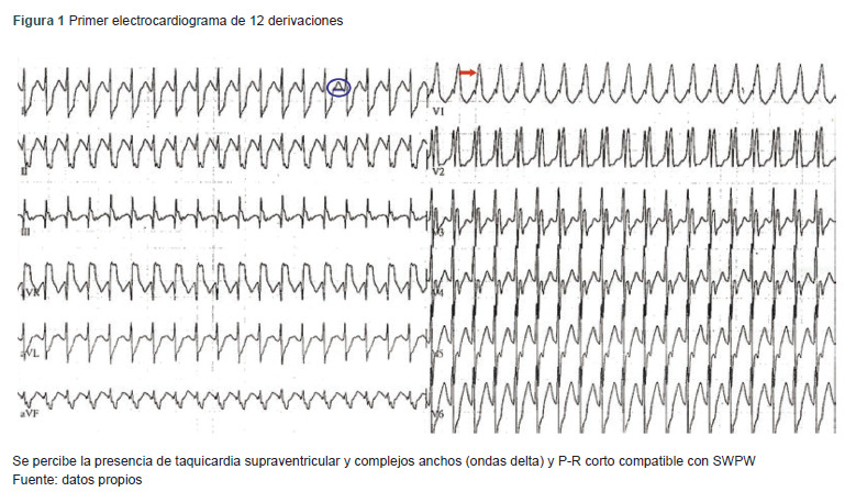 [Wolff-Parkinson-White syndrome due to cocaine use: a case report].