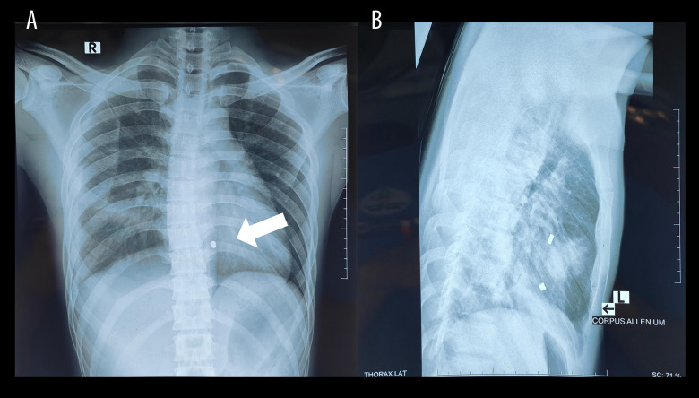 Air Rifle Injury: Rare Bullet Lodgement in the Right Ventricle and Successful Surgical Removal.