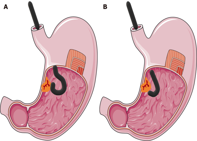 Advances in multibending endoscope: A paradigm shift in minimally invasive diagnostics and therapeutics.