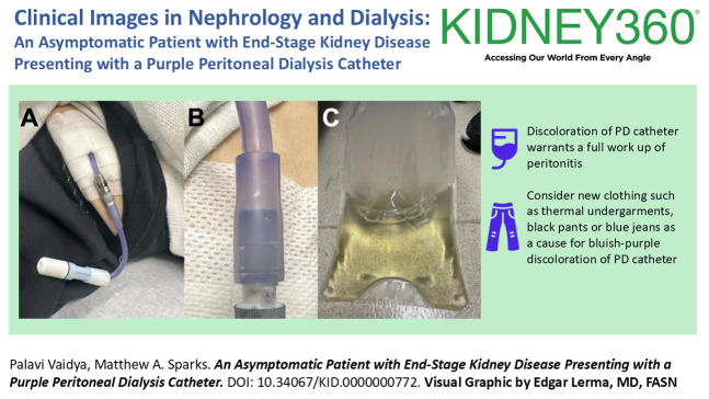 Asymptomatic Patient with ESKD Presenting with a Purple Peritoneal Dialysis Catheter.