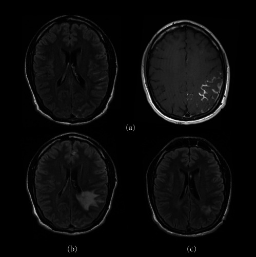 Paradoxical Reactions of Central Nervous System Tuberculosis: Report of Three Immunocompetent Cases.
