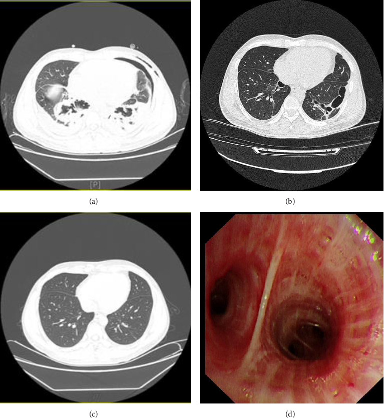 Bronchoalveolar Lavages Combined With Glucocorticoids in Management of Acute Exogenous Lipoid Pneumonia: 3 Case Reports.