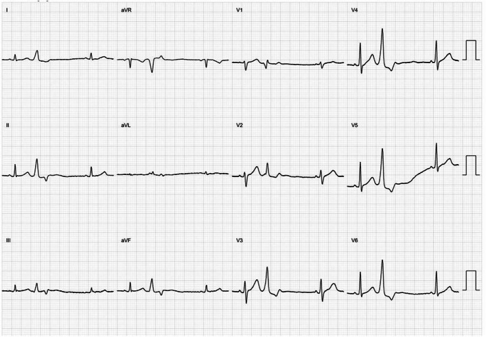 Delayed recurrence of complete atrioventricular block following ablation for premature ventricular complexes.