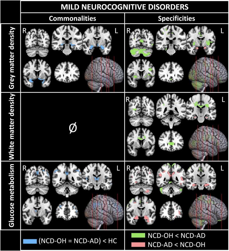 Cognitive and cerebral phenotypes of neurocognitive disorders due to alcohol or Alzheimer's disease.