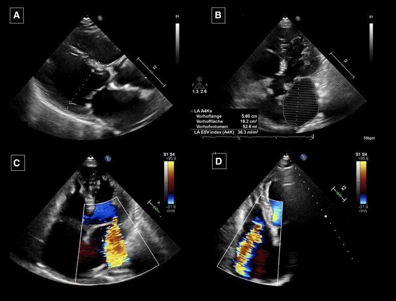 Role of atrial fibrillation ablation in the management of atrial mitral and atrial tricuspid regurgitation: a case report.