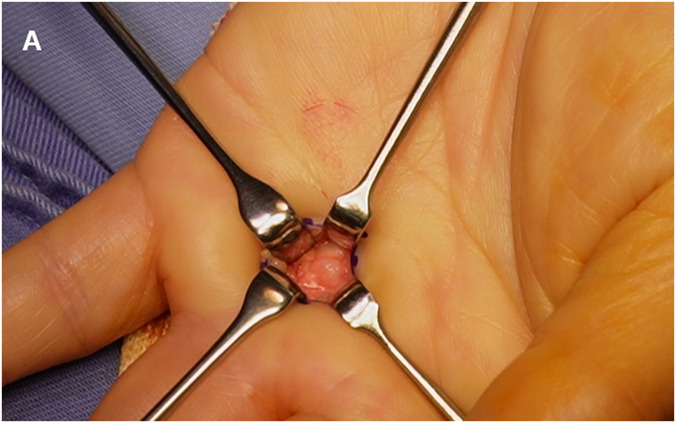 Ganglion Formation After Steroid Injection for Stenosing Flexor Tenosynovitis.