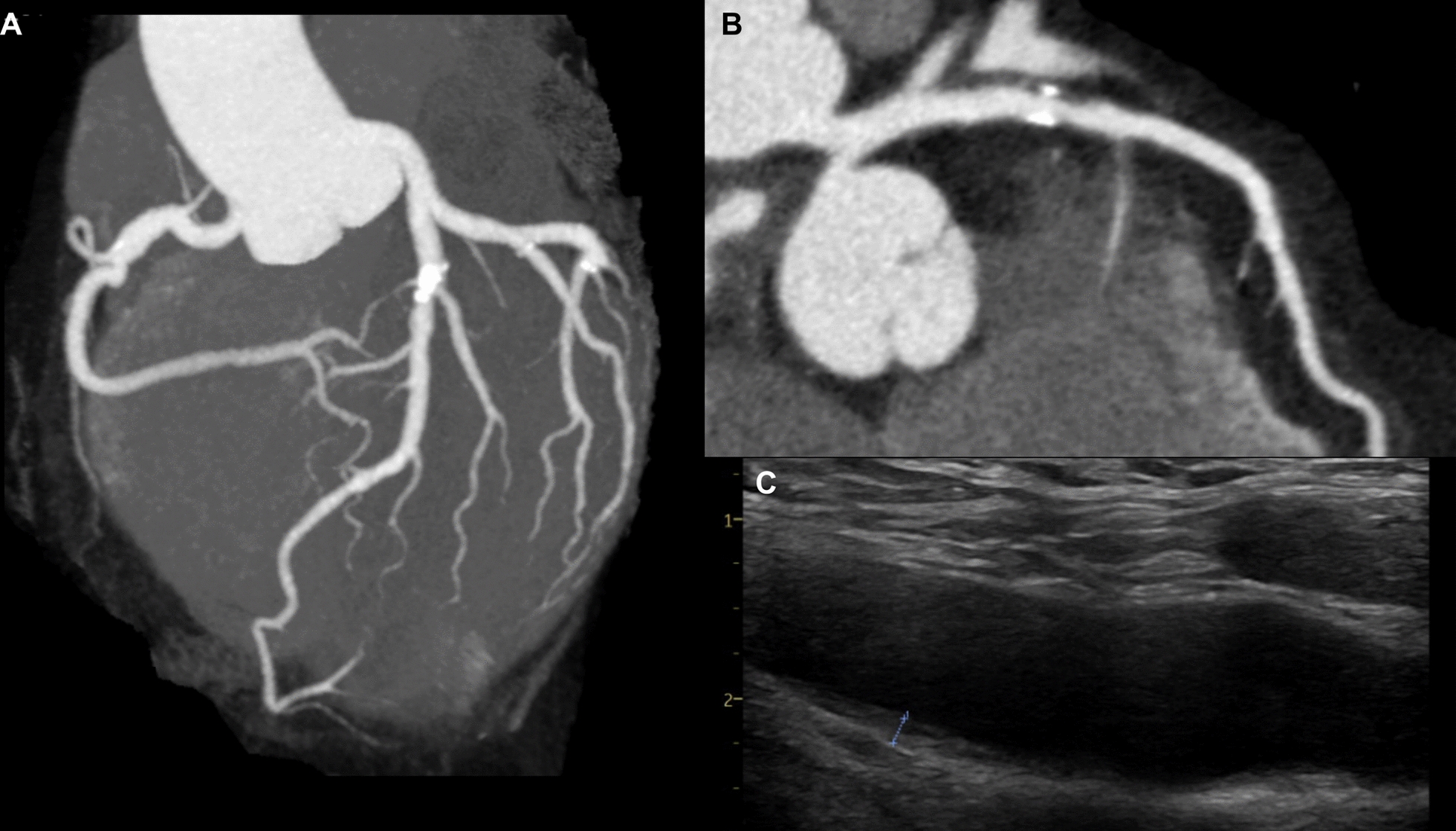 Heterozygous CYP27A1 gene mutation presenting with Achilles tendon xanthoma: a case report.