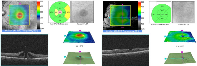 Ganglion cell layer changes following the idiopathic macular hole surgery using inverted limiting membrane flap technique.