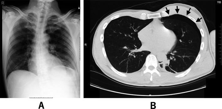 Anesthetic management of occult traumatic pneumothorax with one-lung ventilation avoiding prophylactic chest tube: a case report.