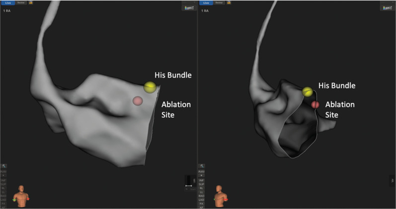 A Novel Technique for Conduction System Pacing in Patients Undergoing Simultaneous Ablation of the Atrioventricular Node Using Axillary Venous Access.