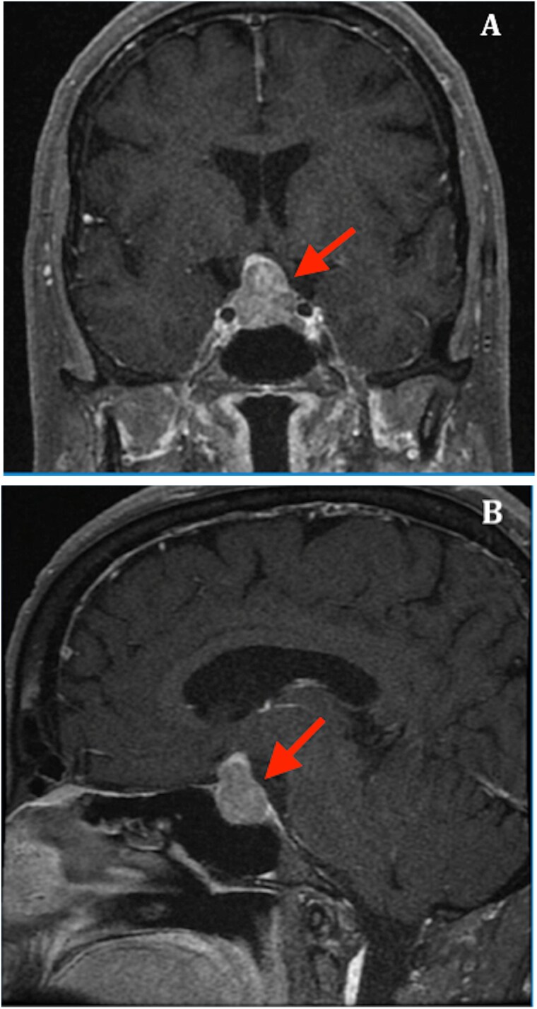 Isolated syndrome of inappropriate antidiuresis (SIAD) after Transphenoidal surgery of a non-functioning pituitary adenoma: clinical case report.