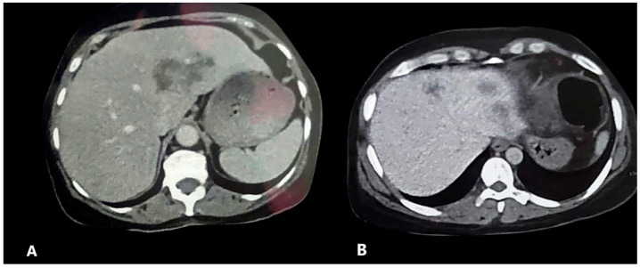 High Efficacy of Triclabendazole/Ivermectin Combination Compared to Triclabendazole Monotherapy for Treating Human Fascioliasis in Upper Egypt: A Prospective Study.