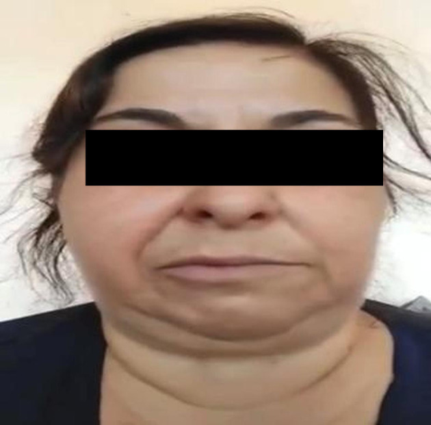 A Successful Treatment of Hemifacial Spasm After Flow Diverter Stent Placement for Ipsilateral Internal Carotid Artery Saccular Aneurysm.