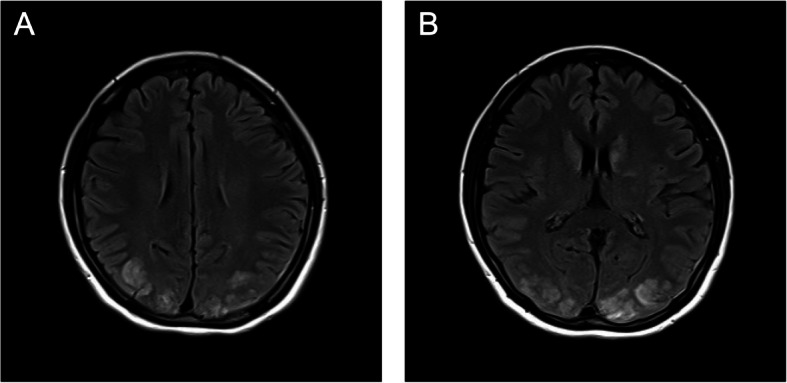 Posterior reversible encephalopathy syndrome during epidural labor analgesia: a case report.