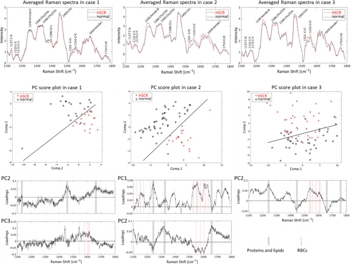 Label-free diagnostic procedure for hirschsprung's disease to detect intestinal mucosal characteristics of aganglionosis by Raman spectroscopy with optimized decision algorithms.