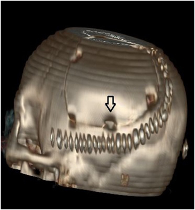 Symptomatic postoperative cyst following glioma excision in a pediatric patient: a case report.