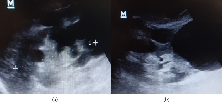 Acute Tubulointerstitial Nephritis (ATIN) in Patient With Autosomal Dominant Polycystic Kidney Disease (ADPKD): A Case Report.