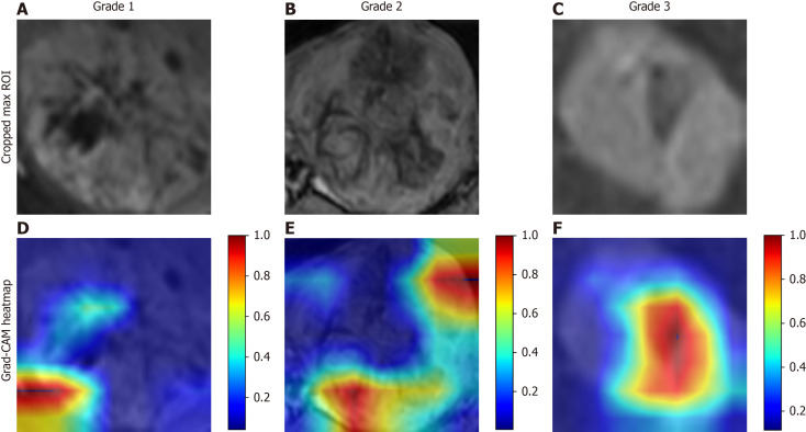 Biparametric magnetic resonance imaging-based radiomic and deep learning models for predicting Ki-67 risk stratification in hepatocellular carcinoma.