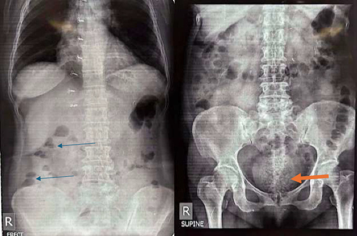 A Rare Case Report on Bowel Obstruction due to Seed Bezoar at the Rectum.