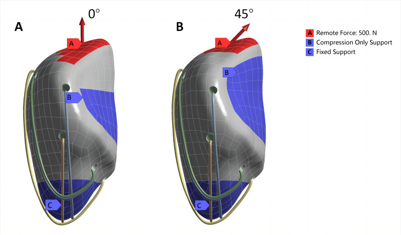 Candy box technique with sutures and Nice knot : a novel approach to inferior pole patellar fractures.