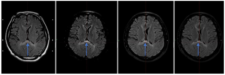 Boomerang Sign in the Splenium of the Corpus Callosum After Vestibullar Schwannoma Treatment: Case Report and Review of the Literature.
