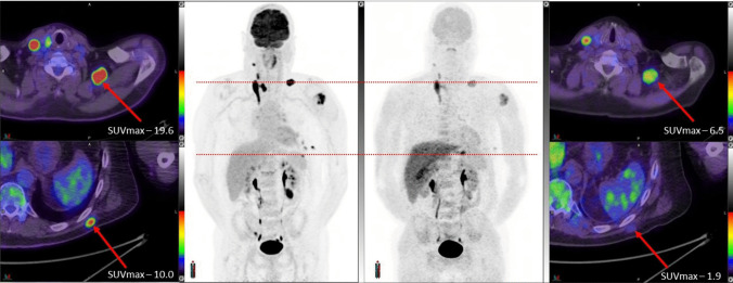 Poor Diagnostic Performance of the Melanin-Binding Tracer [18 F]MEL050 in Human Melanoma Indicates Biological Heterogeneity.