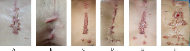 Retrospective study comparing three approaches for keloids: surgery + radiotherapy, surgery + pharmacological injection, and surgery alone.