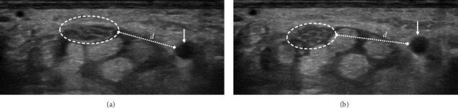 Evaluating Various Ultrasound Criteria for Determining Carpal Tunnel Syndrome Severity.