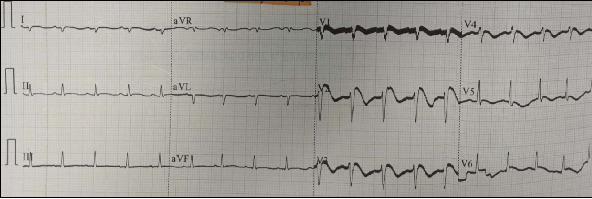 Brugada Phenocopy Associated With Toxic Myocarditis due to Aluminum Phosphide: A Case Report.