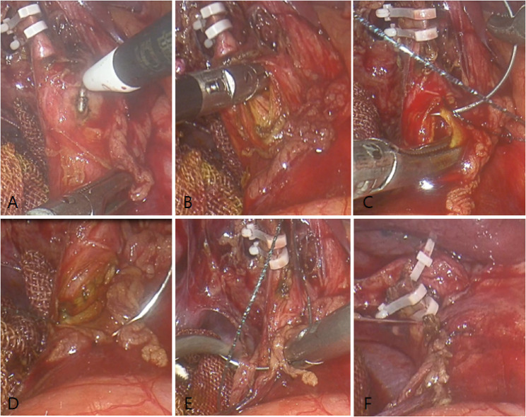 Clinical safety study of laparoscopic common bile duct exploration and primary suture in elderly patients: a new strategy for the treatment of stones.