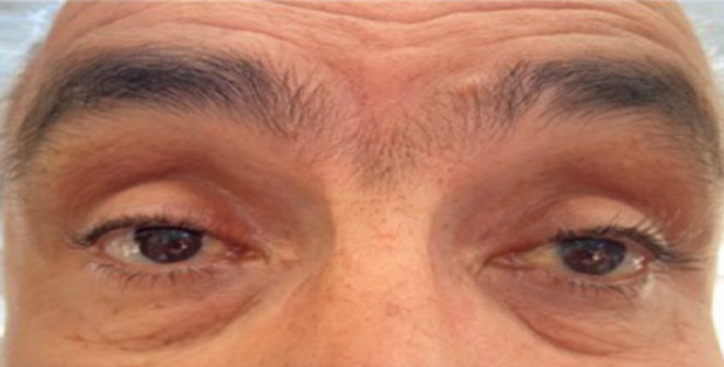 Oculoplastic Challenges in Patients with Glaucoma.