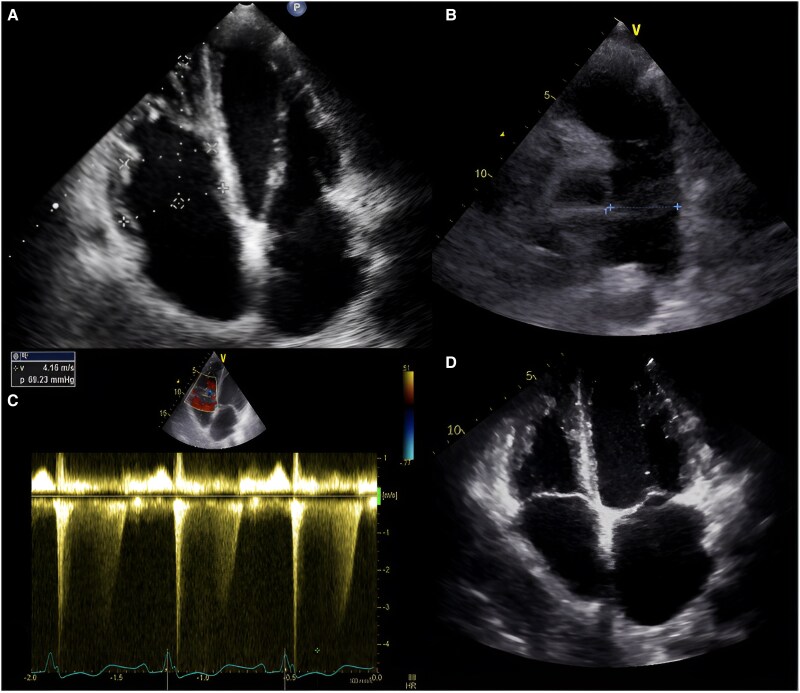 Parkes Weber syndrome, a rare case of pulmonary hypertension: a case report.