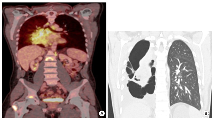 Unilateral cystic and bullous lung changes in a patient treated with brigatinib: a case report.