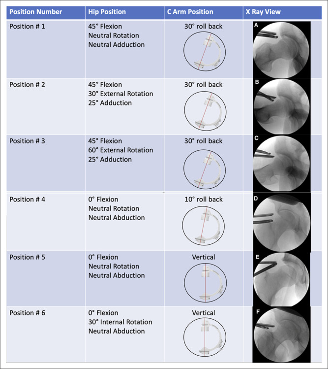Contemporary Techniques in Femoral Osteoplasty.