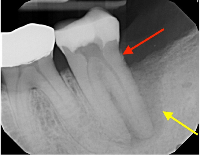 Multidisciplinary management of an endo-perio lesion complicated by a cemental tear: a case report.