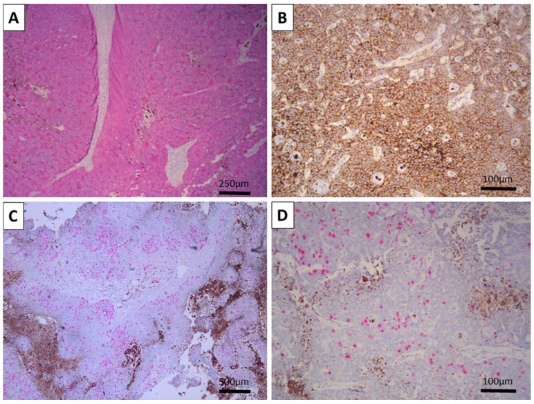 Melanotrichoblastoma: A Histopathological Case Report of a Rare Pigmented Variant of Trichoblastoma.