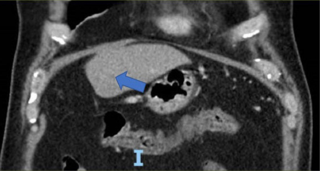 Rapid Metastatic Growth of A Pancreatic Signet Ring Cell Carcinoma within 6 weeks of A Negative CT.
