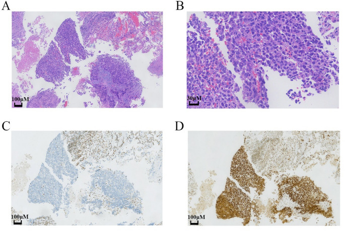 Long-term survival of a SMARCA4-deficient undifferentiated thoracic tumor with brain metastasis successfully treated with multimodal treatment: a case report and literature review.