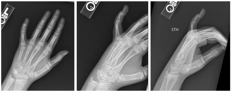 Open Reduction and Internal Fixation of a Volar Displaced Salter-Harris III Mallet Fracture in a Pediatric Patient: A Case Report.