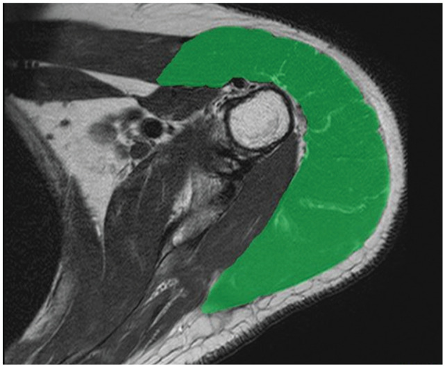 Deltoid Muscle Volume After Superior Capsule Reconstruction in Patients With Irreparable Rotator Cuff Tears: A 3-Dimensional Magnetic Resonance Imaging Analysis.