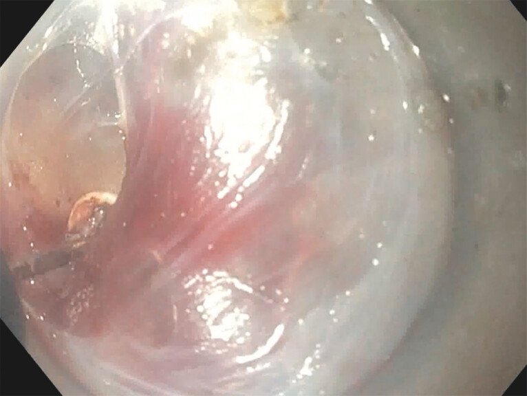 Safety and efficacy of peroral endoscopic myotomy with endoscopic fundoplication compared with POEM alone: International multicenter cohort study.