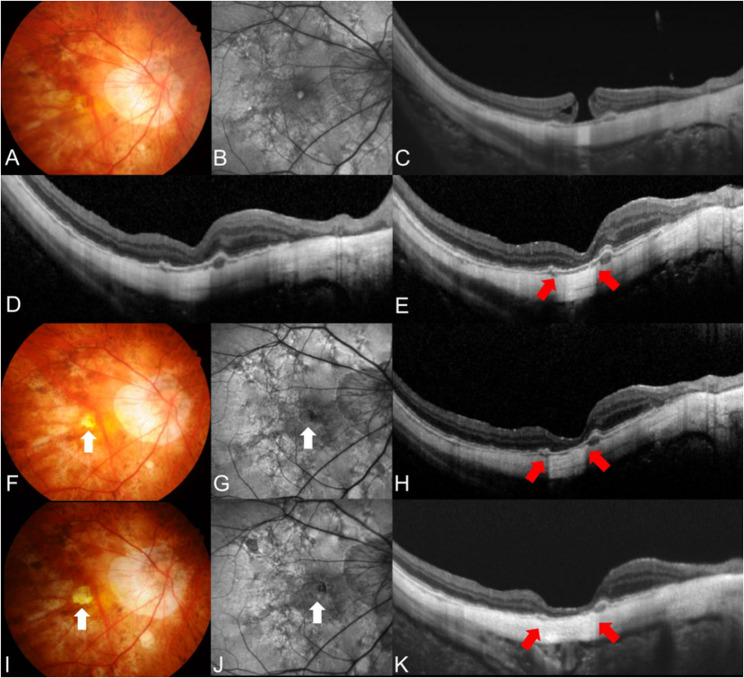 Long-term surgical outcome of high myopic full-thickness macular hole without retinoschisis.