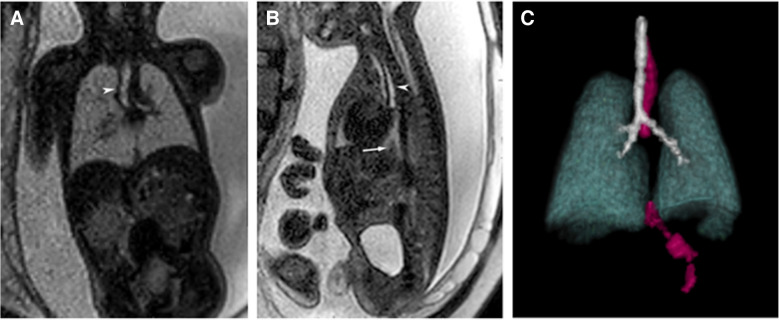 Enhanced fetal MRI diagnosis of esophageal atresia using super-resolution slice-to-volume reconstruction.