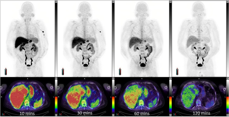 Poor Diagnostic Performance of the Melanin-Binding Tracer [18 F]MEL050 in Human Melanoma Indicates Biological Heterogeneity.